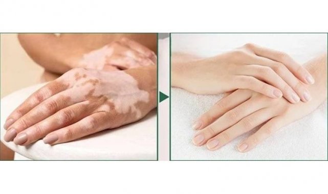 Dünyadaki birçok vitiligo hastası çareyi Bursa'da buluyor