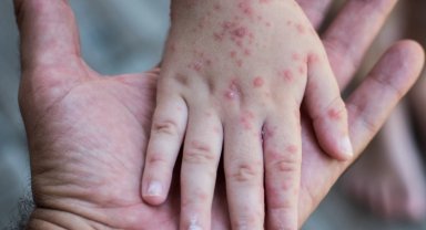 Küçük Ellerde Büyük Risk: El, Ayak, Ağız Hastalığına Dikkat!